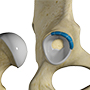 Labral Reconstruction