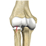 Radial Head Fracture